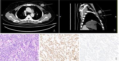 HER-2-positive primary neuroendocrine neoplasms of the breast with signet ring feature: A case report and review of literature
